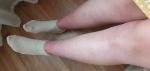 Фиолетовые пятна, тяжесть и боли в ногах фото 2
