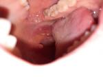 Опухоль в полости рта фото 1
