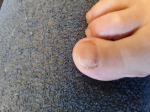 Изменение гостевой пластины на большом пальце ноги фото 2