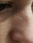 Дефект кожи у носа фото 1