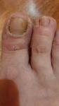 Грибок ногтей рук и ног, шелушение кожи и зуд фото 1