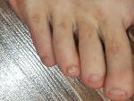 Грибок ногтя на безымянном пальце фото 1