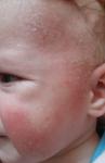 Высыпания на коже ребенка уже продолжительностью 4 месяца фото 5