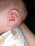 Сыпь на лице у новорожденного фото 1