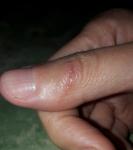 Глубокий порез пальца фото 1