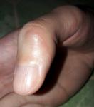 Глубокий порез пальца фото 2