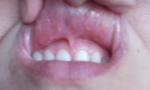 Узнать диагноз, слизистая оболочка губы опухла болит, и белые пятнышки фото 1