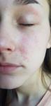 Аллергия на лице с гнойными прищиками фото 1