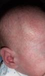 Сыпь на лице у новорожденного фото 3