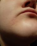 Красное шелущащиеся пятно на лице с точками фото 2