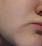 Красное шелущащиеся пятно на лице с точками фото 1