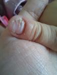 Проблема с ногтями на руке, грибок фото 3