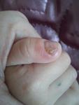 Проблема с ногтями на руке, грибок фото 2