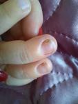 Проблема с ногтями на руке, грибок фото 1