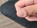 Воспаление на большом пальце руки около ногтя фото 3