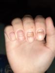Заболевание ногтей, ногти растут неровно фото 1