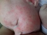 Аллергия на БКМ или акне новорожденных фото 1