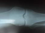 Хронический тонзиллит и колено фото 4