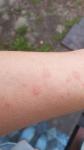 Аллергия красные пятна фото 2