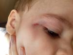 Ребёнок 2 года, ударился глазом фото 1
