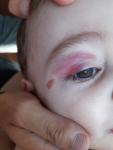 Ребёнок 2 года, ударился глазом фото 2
