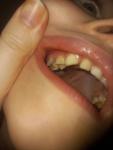 Зуб болит но есть пломба фото 2