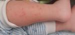 Аллергия у ребенка, весь чешется, на теле сыпь фото 1