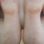 Горизонтальные пятна на больших пальцах ног фото 1