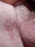 Воспаление кожи в промежности фото 4