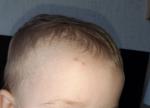 Высыпания на лице и голове у ребёнка 1,5 года фото 1
