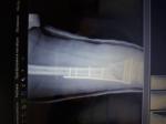 Открытый оскольчатый внутрисуставной перелом бедренной кости фото 3