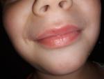 Красное пятно на губе у ребенка фото 2