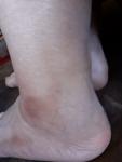 Черные пятна на локте и ноге вокрук сухая кожа фото 2