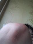 Черные пятна на локте и ноге вокрук сухая кожа фото 1