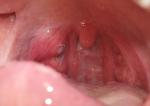 Воспаление в горле, болезненные ощущения при глотании фото 1