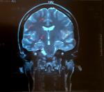 Результаты МРТ. Есть ли вероятность опухоли мозга? фото 3