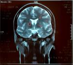 Результаты МРТ. Есть ли вероятность опухоли мозга? фото 5