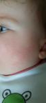 Высыпания на щеках у ребенка фото 2