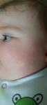 Высыпания на щеках у ребенка фото 1
