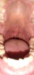 Опух язычок красное горло фото 1