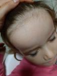 У ребенка мелкая сыпь на лице, девочке 3,5 года фото 1