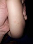 Сыпь на руках и ногах у ребенка 2 года фото 3