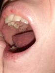 Боль в щеке после лечения зуба семёрки фото 1