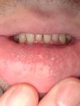 Высыпания на внутренней стороне нижней губы фото 1