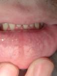 Высыпания на внутренней стороне нижней губы фото 2