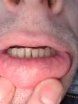 Высыпания на внутренней стороне нижней губы фото 3