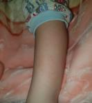 У ребенка на ножках розовые, шершавые пятнышки фото 2
