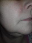 Высыпания на коже лица в области носа, щек и подбородка фото 3
