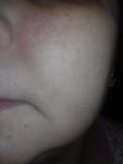 Высыпания на коже лица в области носа, щек и подбородка фото 2