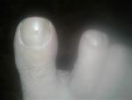 Пятно под ногтем на большом пальце ноги фото 1